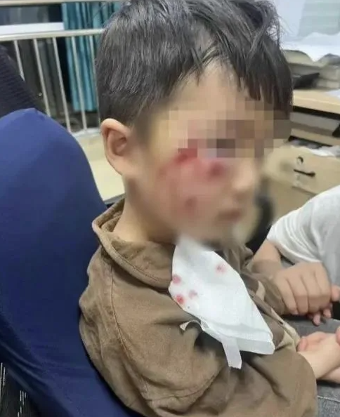 被疯犬咬伤没有“救命药”，怎么办？